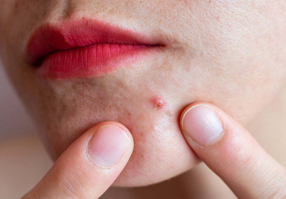 در بسیاری از موارد با از میان نرفتن عامل اصلی، آکنه دوباره روی پوست ظاهر می‌شود