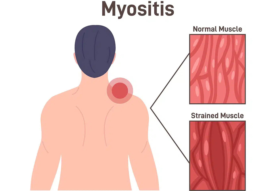 علائم Myositis در طول زمان و به مرور ظاهر می‌شوند