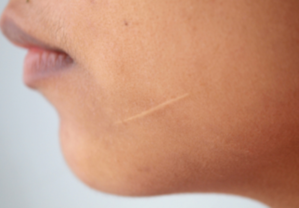 جلوگیری از ایجاد اسکار پوستی از زمان ایجاد زخم آغاز می‌شود و می‌توان با اقدامات پیشگیرانه از بروز اسکار پوستی جلوگیری کرد